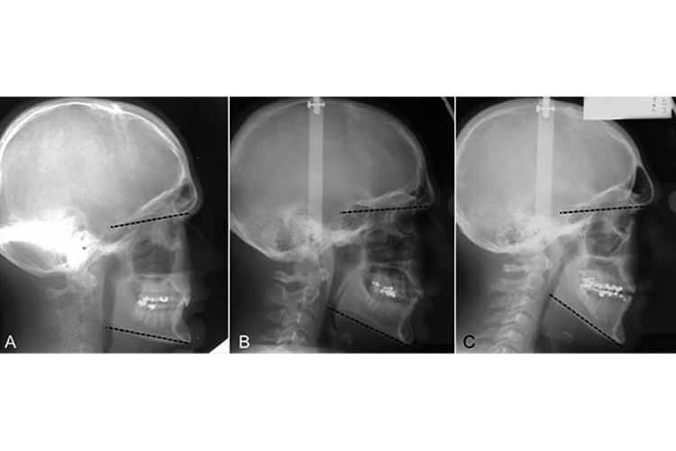 Lateral cephalograms demonstrating examples of hypo‐divergent (A), normo‐divergent (B) and hyper‐divergent (C) facial types.