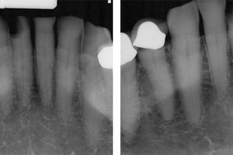 Radiograph of distal D3 approximal lesion on tooth #25. The technique known as SMART could help repair tooth damage and prevent caries without requiring multiple appointments.