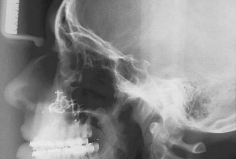 A radiograph of the jaw area. Image courtesy of Dr. Anders Nattestad.